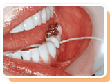 치실을 치아사이에 위치 시킨 이미지
