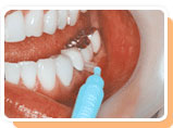치간 브러쉬를 바깥쪽 치아사이에 위치 시킨 이미지